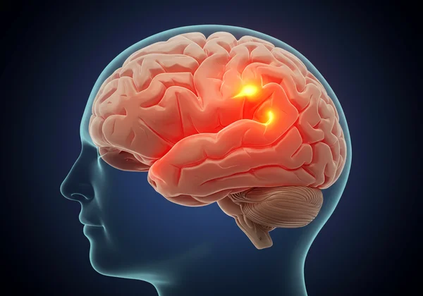 Illustration of a brain with an active, red amygdala.